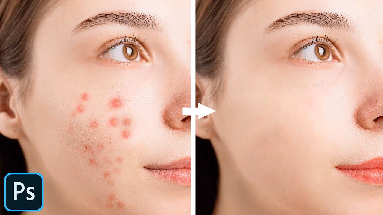 How can I edit acne in photos?