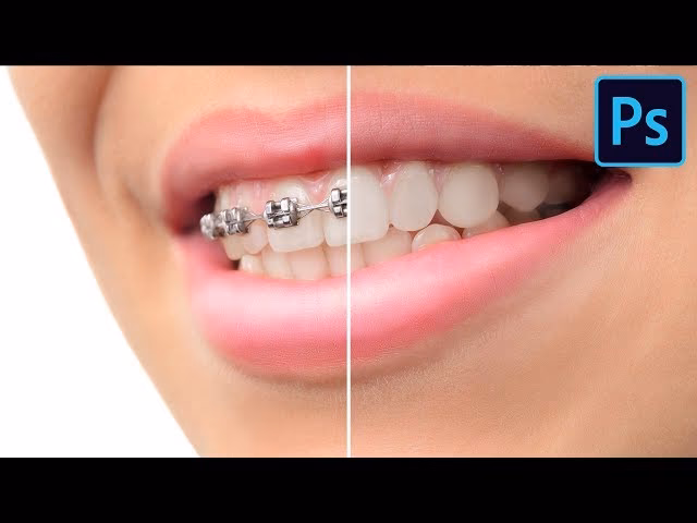Can braces be edited in Photoshop?