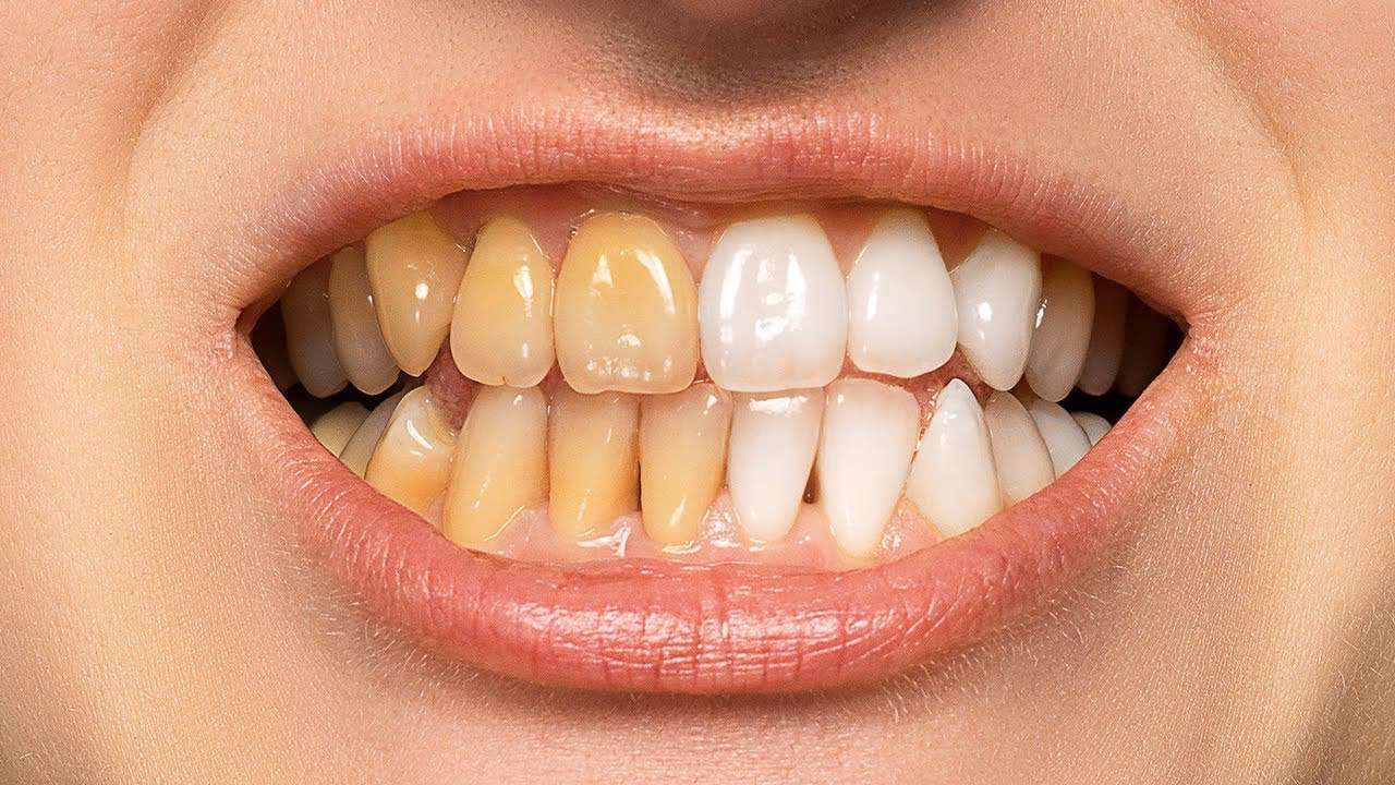 How to make white teeth?